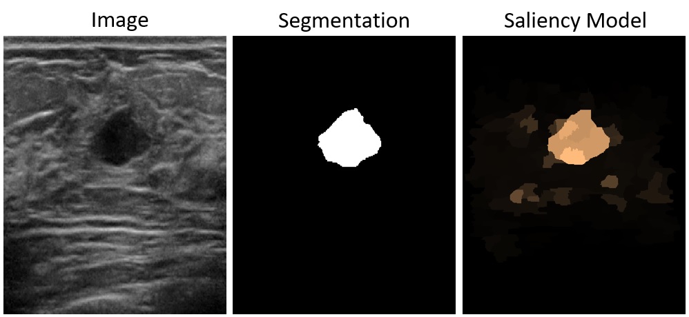 Breast ultrasound image example